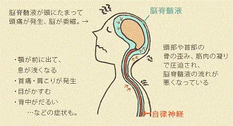 頭痛や視覚障害など脳脊髄液の滞りによる健康問題